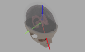 3D Modeling for simulated ventricular surgery